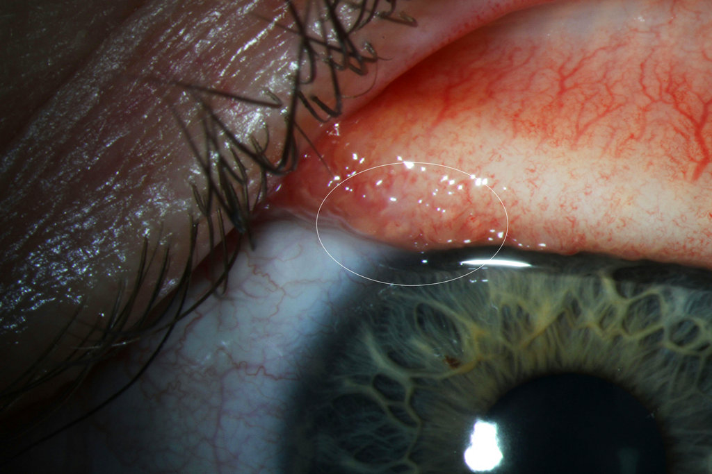 14 worms pulled from woman's eye after rare infection